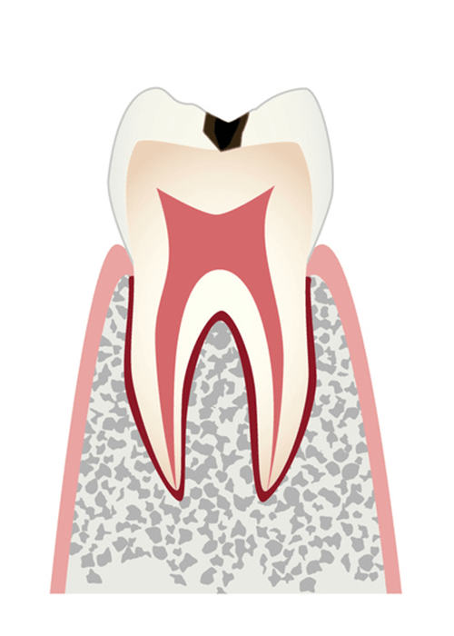 表層の虫歯